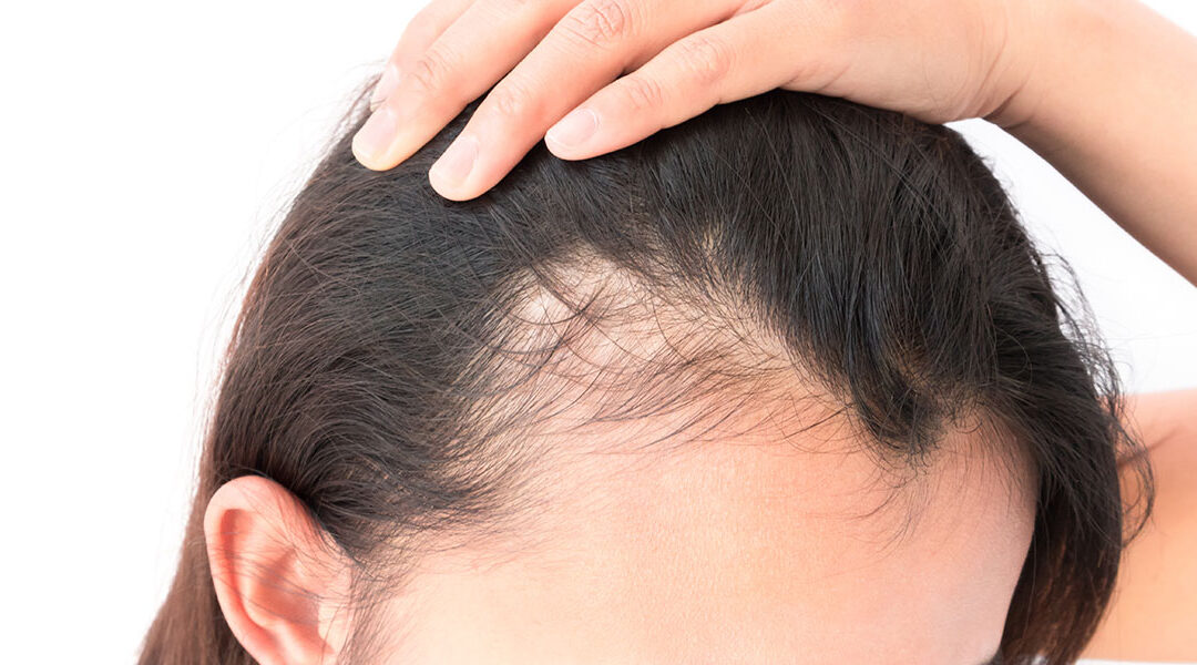 Does Stress Cause Hair Loss?
